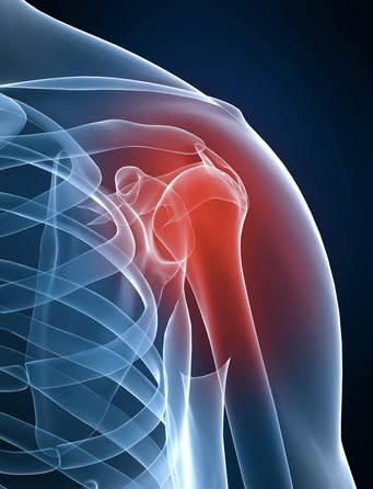 Why Does My Shoulder Keep Dislocating? Common Causes and Ways to Improve Stability